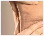 Cellulite bei Männern