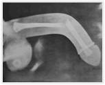 penis-fracture-ALT_SMALL_IMG